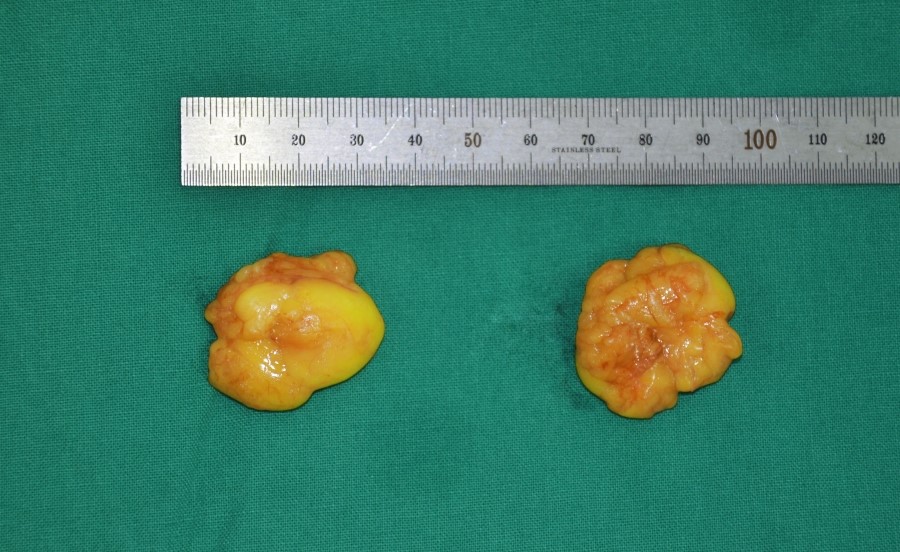The Amount of Deep Buccal Fat Removed During Deep Buccal Fat Removal image 1