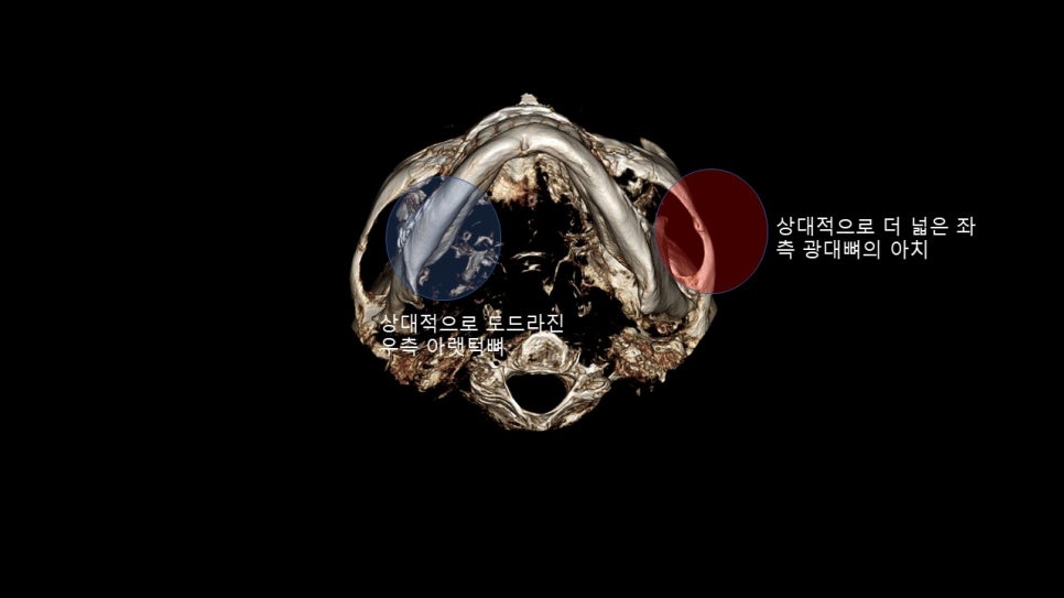 광대뼈축소성형술 증례 리뷰 -1 관련 이미지 2