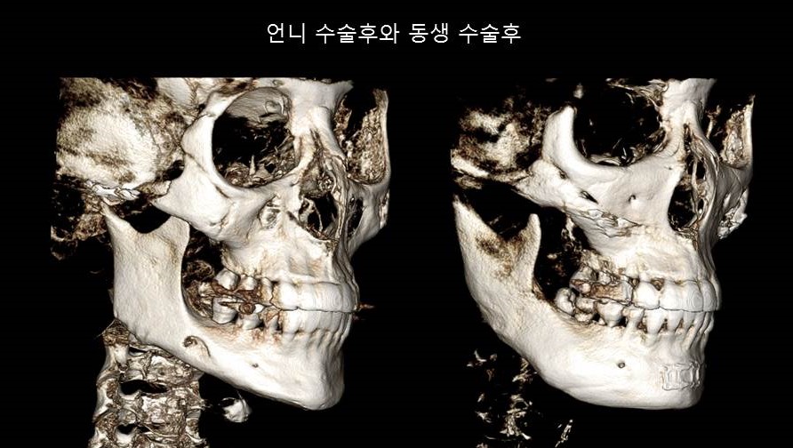 Understanding Square Jaw Surgery - Comparison of Postoperative Results Between Biological Sisters Who Underwent Surgery Using Different Methods image 7