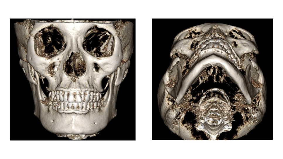 Why Cheekbone Revision Surgery for Sagging Cheeks and Nonunion 30 Years After Cheekbone Surgery Succeeded After a Facelift image 1