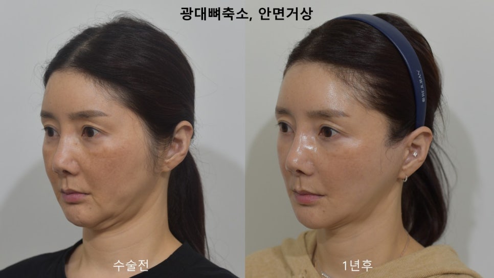 "윤곽거상 수술 " 실제 사례 소개 관련 이미지 2