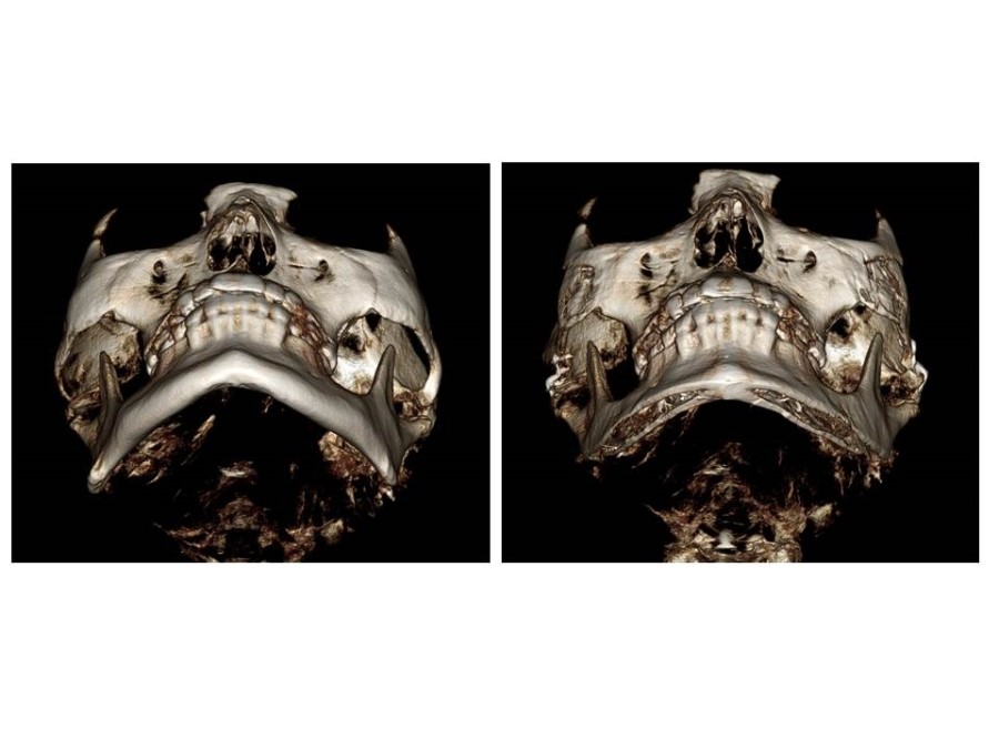Proper Understanding of Cortical Bone Resection or Cortical Bone Reduction in Square Jaw Surgery image 7