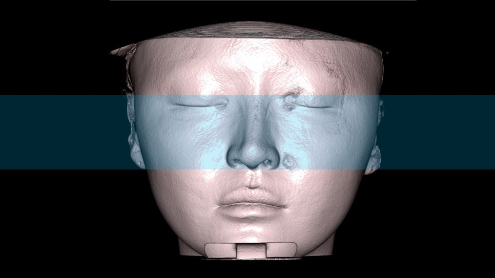How Is Face Shape Determined? Factors That Determine Face Shape and Facial Contouring Surgery image 10