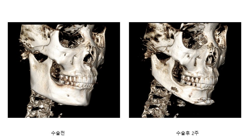 사각턱 수술후 시기에 따른 아랫턱뼈의 형태변화 관련 이미지 11