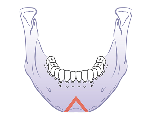 V-Line Square Jaw Surgery - The Appropriate Surgical Method According to the Shape of the Chin image 5