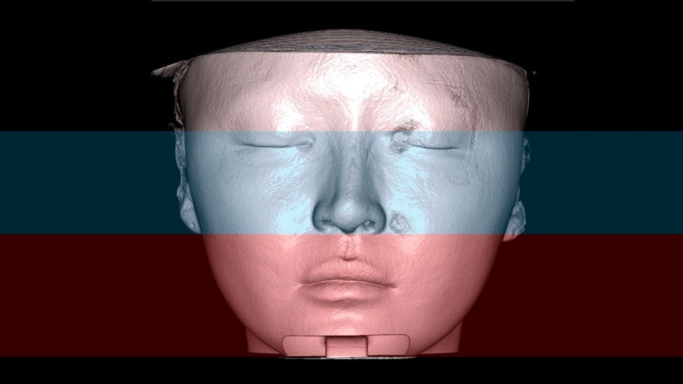 How Is Face Shape Determined? Factors That Determine Face Shape and Facial Contouring Surgery image 9