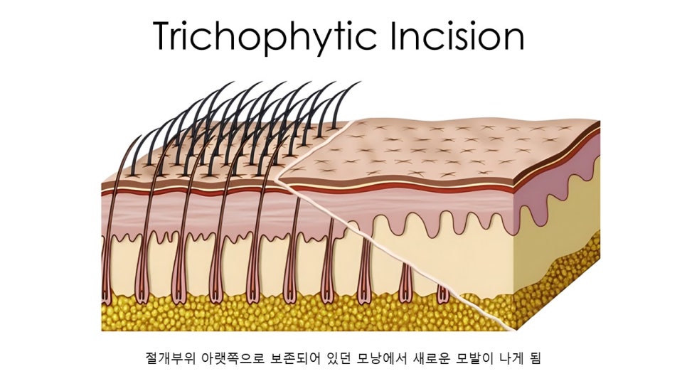 넓은 이마와 처진 눈매 고민 끝! "이마거상, 이마축소, 그리고 바이나리" 관련 이미지 11