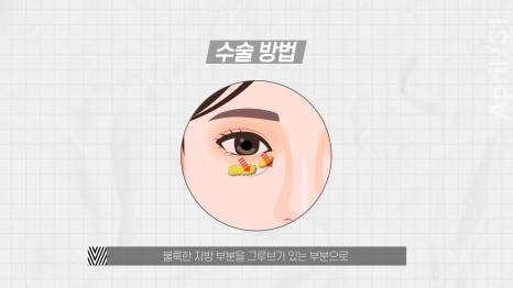 Can You Go Back to Work After Lower Eyelid Fat Repositioning? Yes or No?! (feat. Lower Eyelid Fat Repositioning vs. Lower Blepharoplasty) image 7