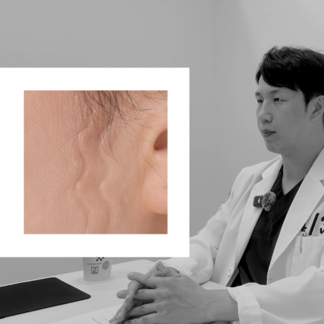 [4월31일성형외과] 실리프팅, 효과 보는 얼굴 따로 있다? 관련 이미지 16