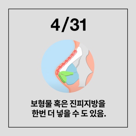 [코성형] 코에 넣은 자가진피, 마음에 안든다면? 관련 이미지 8