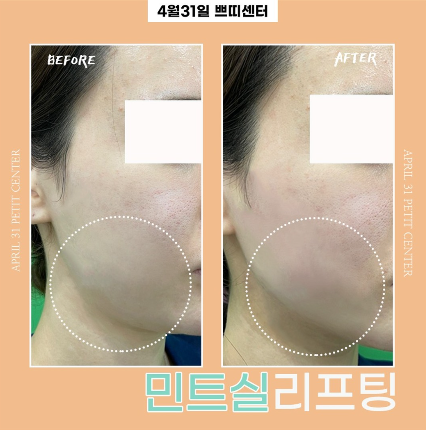 Where is the best dermatology clinic for Mint thread lifting near Hakdong Station and Gangnam Station? Criteria for choosing a dermatology clinic! image 7