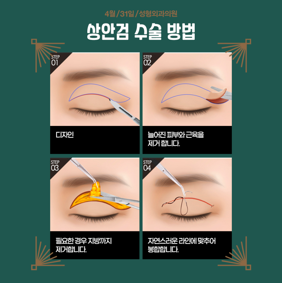 상안검수술잘하는병원에서 동안얼굴을 가져보세요 관련 이미지 4