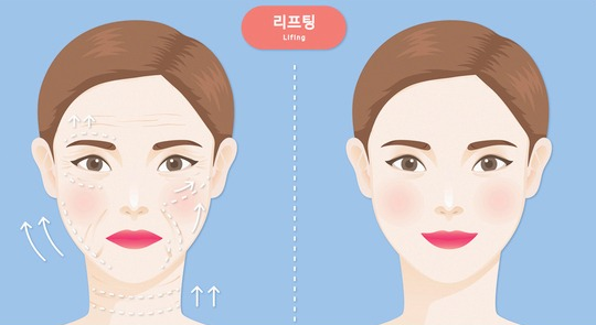 Looking 10 Years Younger with Nasolabial Fold Treatments (Botox/Filler/Thread Lifting) image 7