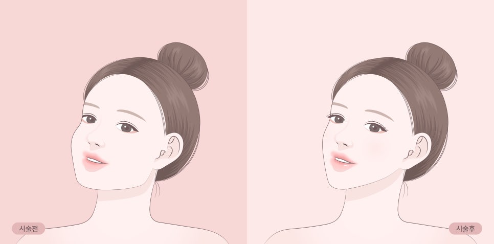 Make an Oval, V-Line Face with Chin Filler + Chin Botox! image 6