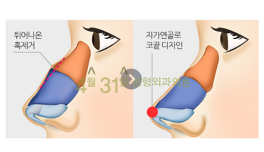 매부리코교정 확실하게 4월31일성형외과에서 관련 이미지 5