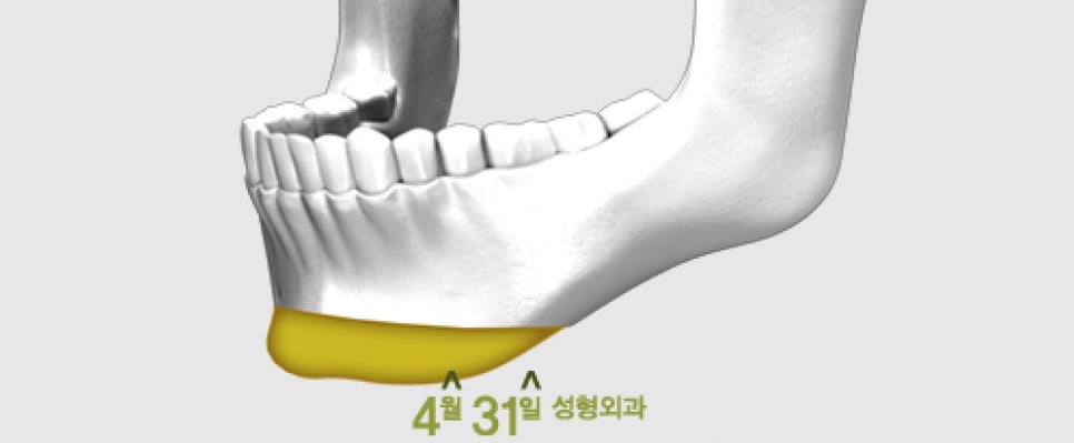 무턱수술후기 4월31일성형외과의 포인트! 관련 이미지 4