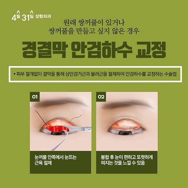 눈매교정잘하는곳 나에게 어울리게 4월31일성형외과 관련 이미지 4