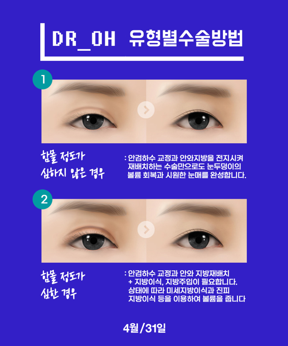 꺼진눈성형비용 시원하고 동안눈매를 원한다면 관련 이미지 4