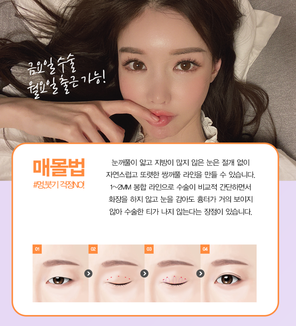 쌍수추천병원 에서 말하는 눈성형종류 관련 이미지 2