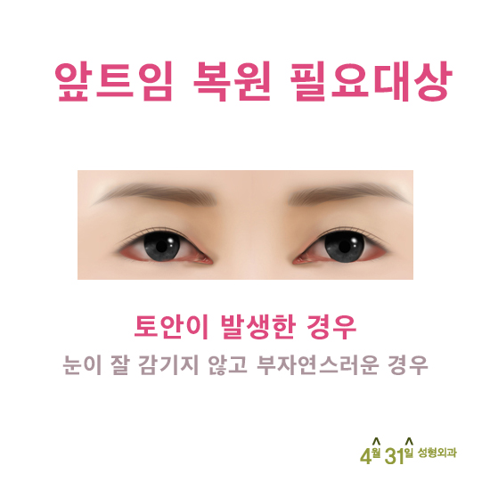 앞트임복원후기 좋은 곳 4월31일성형외과 관련 이미지 2