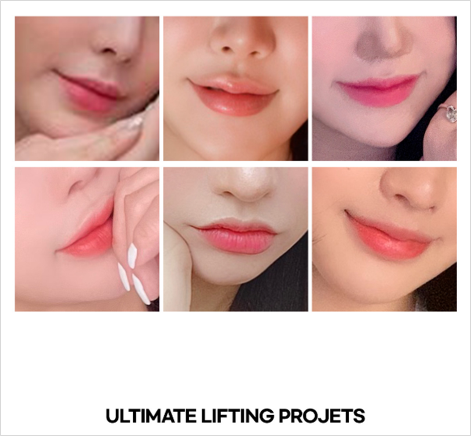 Full Lip Package That Gives You Plump, Glossy, Cherry Lips! (Lip Filler + Lip Corner Filler + Lip Corner Botox) image 3