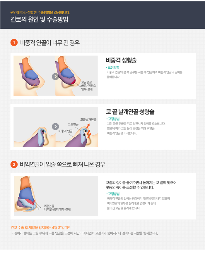 긴코성형 자연스러움은 4월31일성형외과 관련 이미지 2