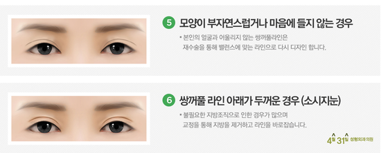 쌍수재수술병원 전담의료진 있는 4월31일성형외과의원 추천 관련 이미지 3