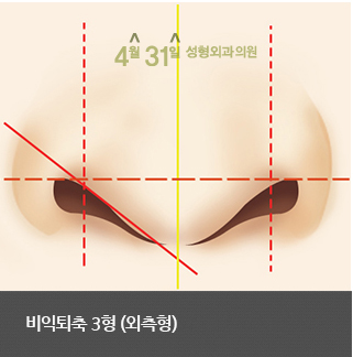 콧구멍성형 비익퇴축술 4월31일 성형외과의원에서 관련 이미지 6