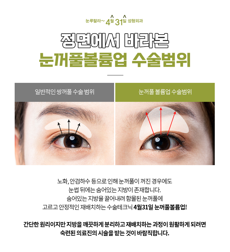 꺼진 눈 교정 지방이식 안전하게 하는 방법 눈꺼풀볼륨업으로!! 관련 이미지 4