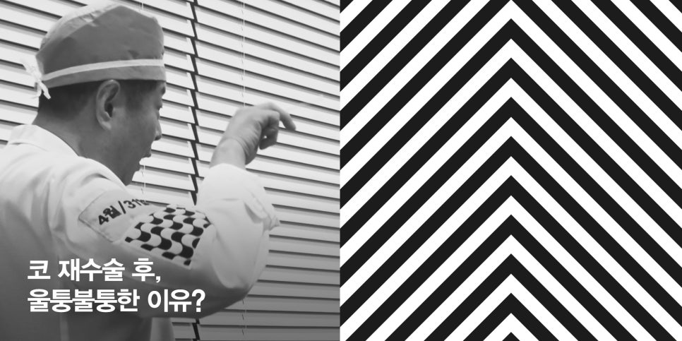 [4월31일성형외과] 코 재수술 후, 울퉁불퉁한 이유? 관련 이미지 1