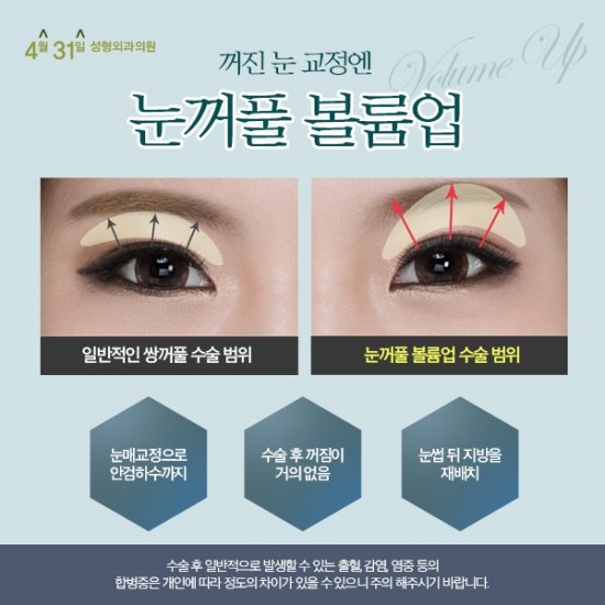 꺼진눈꺼풀교정 4월31일성형외과는 어떻게? 관련 이미지 2