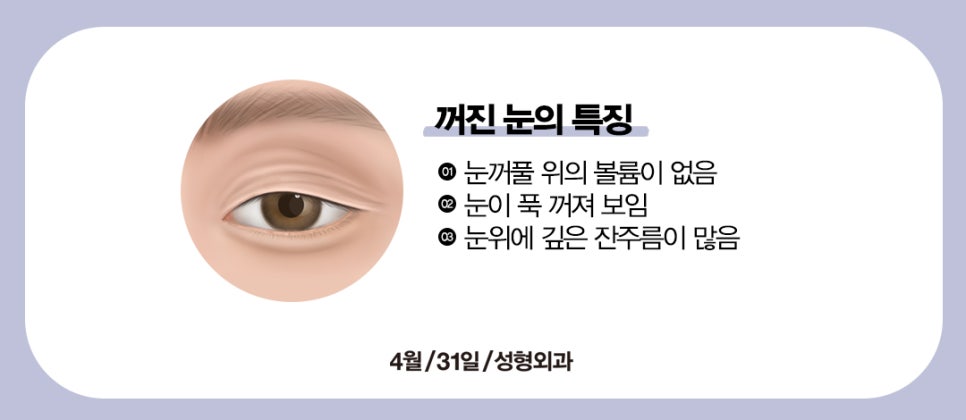 [Eye Surgery] Swelling and Scarring After Double Eyelid Surgery image 6
