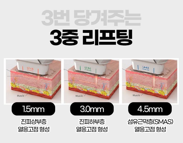 강남 리프팅 추천, 올리슈(올리지오+리프테라+슈링크)로 3배 강력하게! 관련 이미지 5