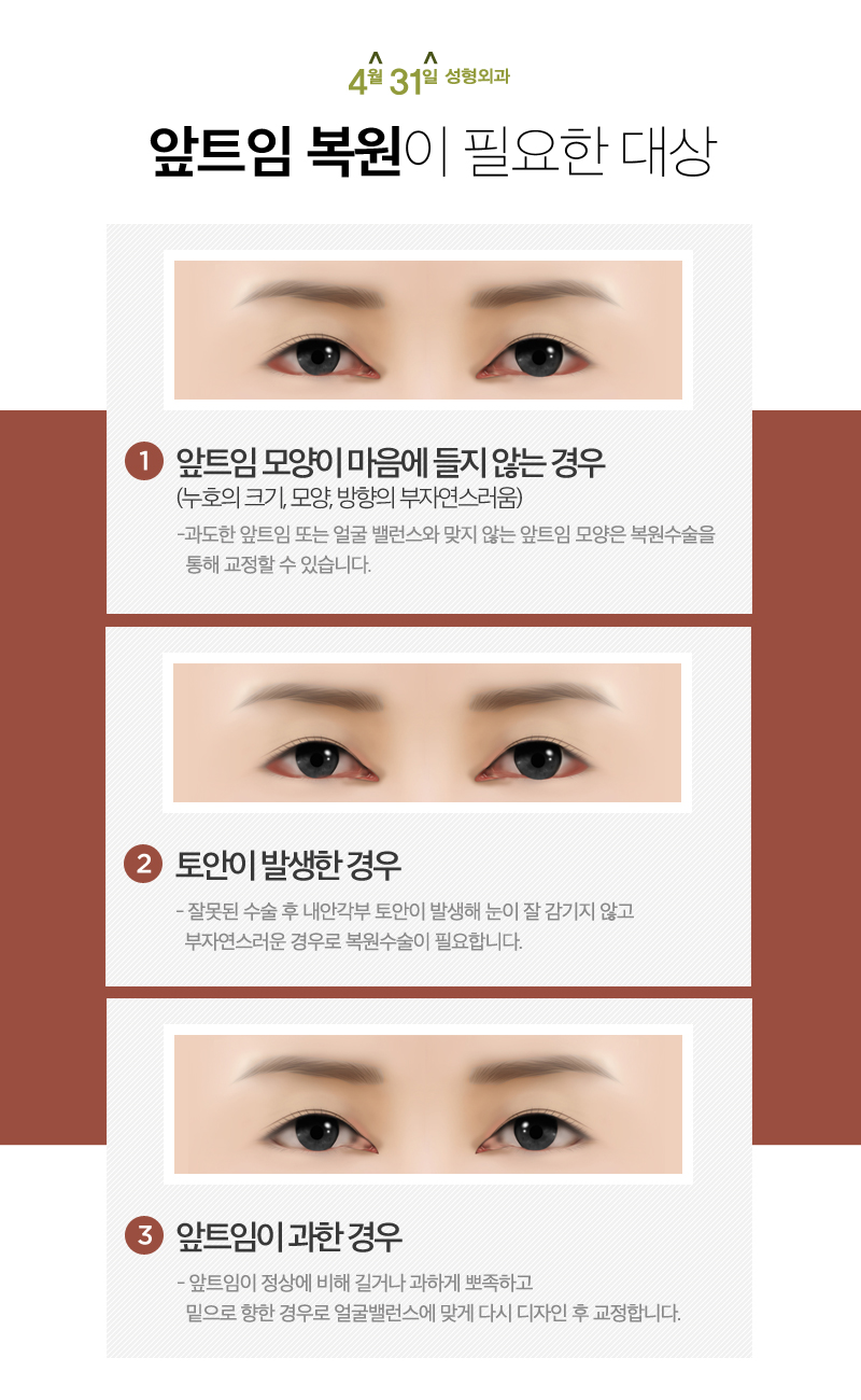앞트임복원후기 4월31일성형외과로 봤어요 관련 이미지 4