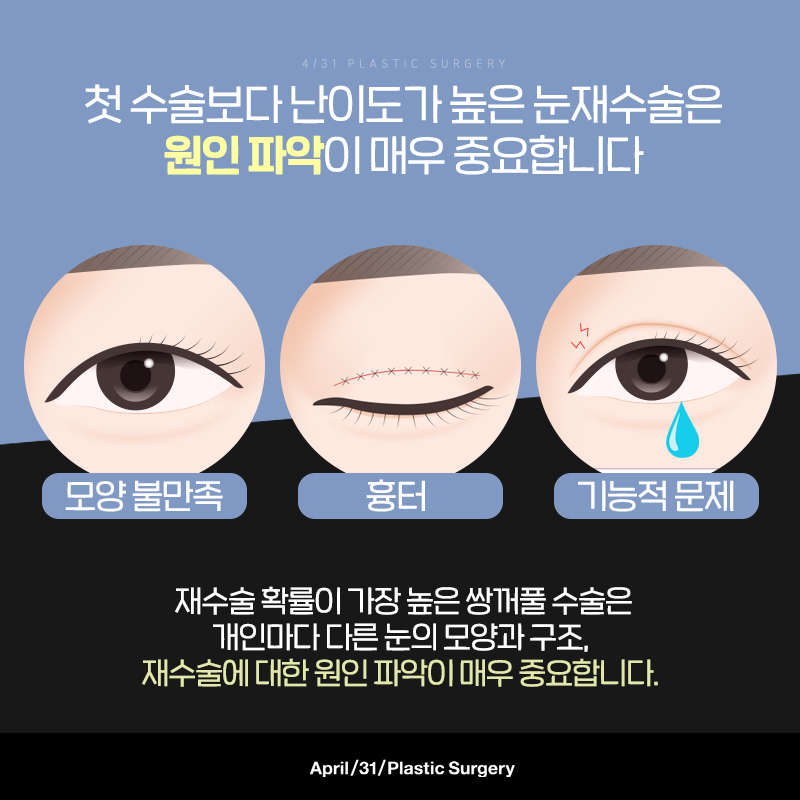 [눈성형] 난이도 높은 눈재수술! 실패 없는 쌍꺼풀재수술 관련 이미지 3
