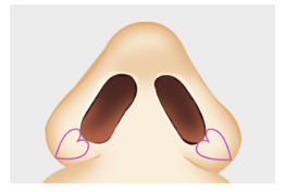 [Nose Surgery] Is It Possible to Reduce a Bulbous Nose with Alar Reduction? Yes or No? image 3