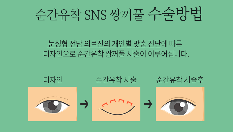 눈성형외과유명한곳 순간유착은 4월31일성형외과 관련 이미지 1