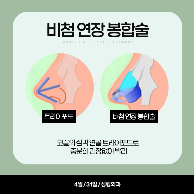 [구축코] 구축코 교정술 5단계 심층분석 Part03_이완시킨 연골 구조의 고정 관련 이미지 3