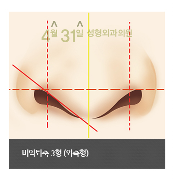 비공내리기 콧구멍교정 잘하는 4월31일성형외과의원에서 관련 이미지 4