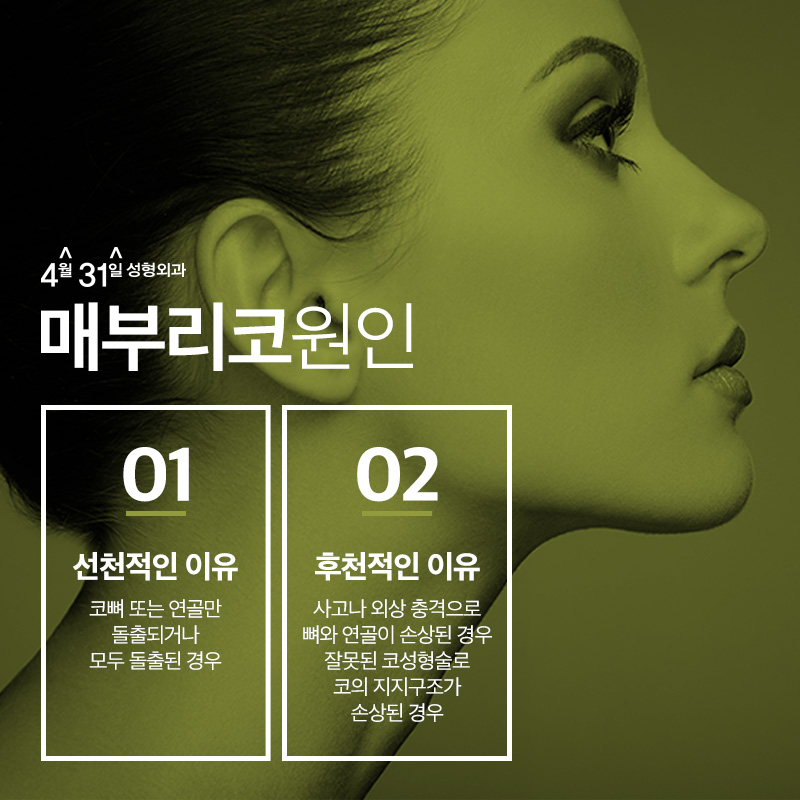 강남매부리코수술 4월31일성형외과에서 매끈하게 관련 이미지 3