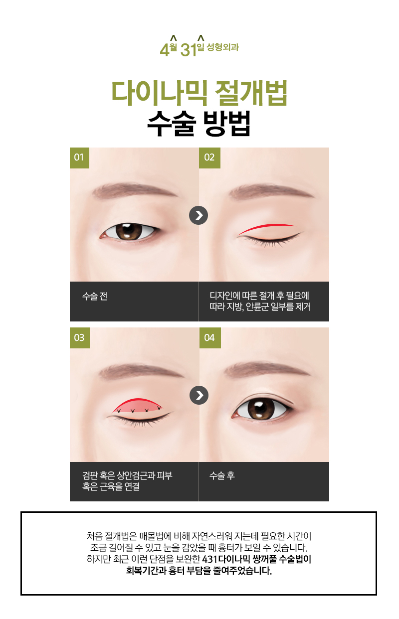 절개법쌍꺼풀 신중한 선택이 만드는 아름다움 관련 이미지 5