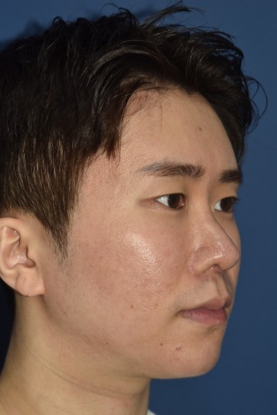 믿을수 있는 구축코재수술 전문 4월31일성형외과 관련 이미지 8