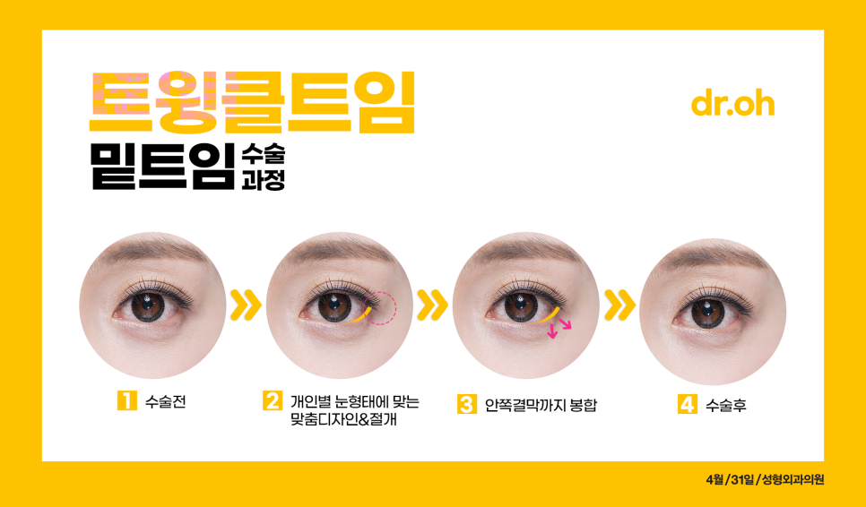 Back Canthoplasty and Lower Canthoplasty Price: If You Want a Bright, Open Eye Shape, Try Twinkle Canthoplasty! image 5