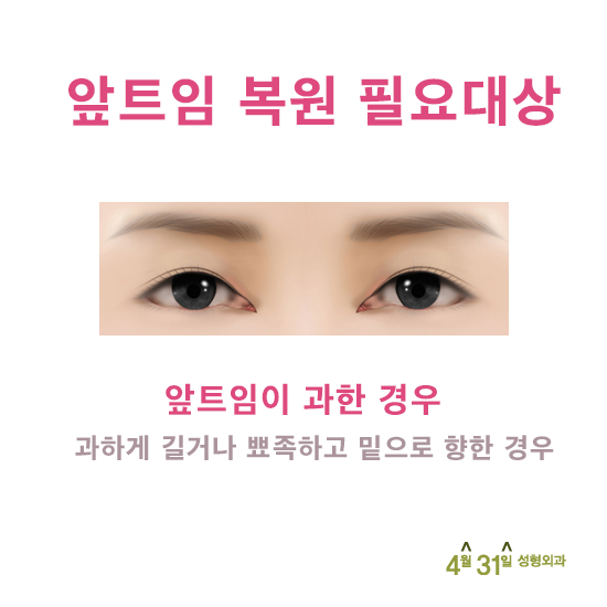 앞트임복원후기 좋은 곳 4월31일성형외과 관련 이미지 4