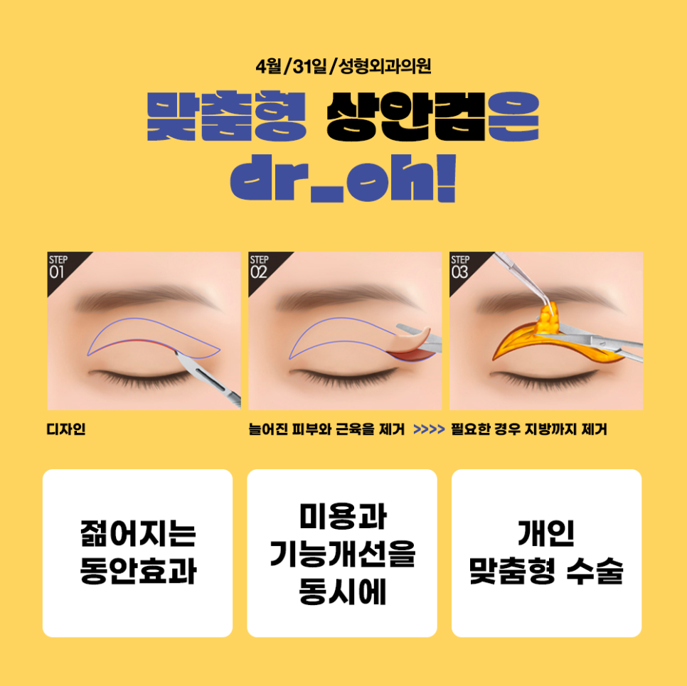 강남상안검수술로 늘어진 눈매를 또렷하게 관련 이미지 4