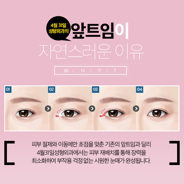 쌍꺼풀앞트임 흉터 걱정 없도록 4월31일성형외과 관련 이미지 2