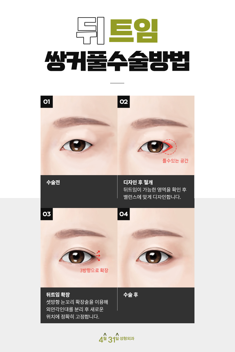 The Effect of Lateral Canthoplasty: No More Feeling Constricted image 6