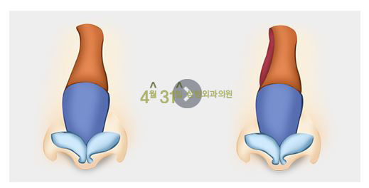 휜코수술잘하는곳 4월31일성형외과의원 입니다. 관련 이미지 3