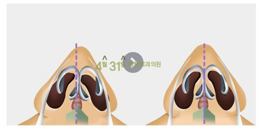 휜코수술잘하는곳 4월31일성형외과의원 입니다. 관련 이미지 4