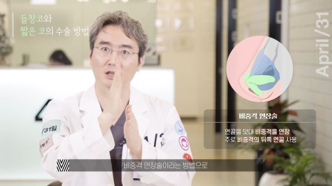 [코성형] 짧은코?들창코? 상태에 따른 수술방법 전격공개! 관련 이미지 7